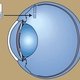 Схема введения капсулы с цефалоспорином в глаз, пораженный увеитом